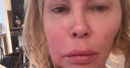 Brandi Glanville Reveals Face Lumps Are Affecting Her Teeth